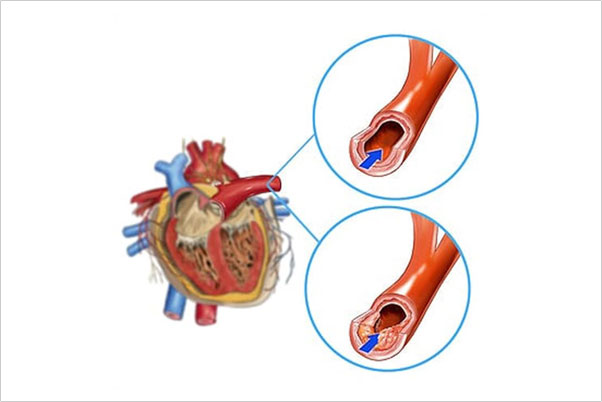 Mediterranean Diet for heart